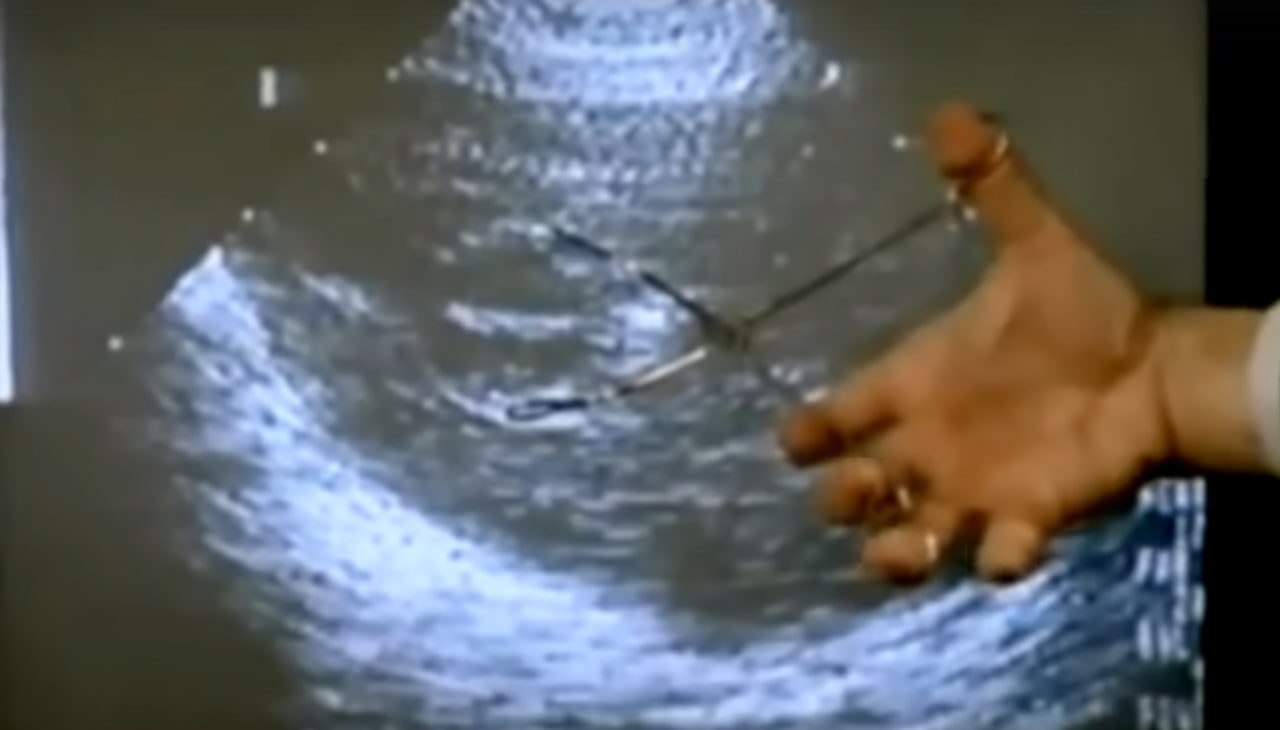 Аборты были основной причиной смерти во всем мире в 2024 году